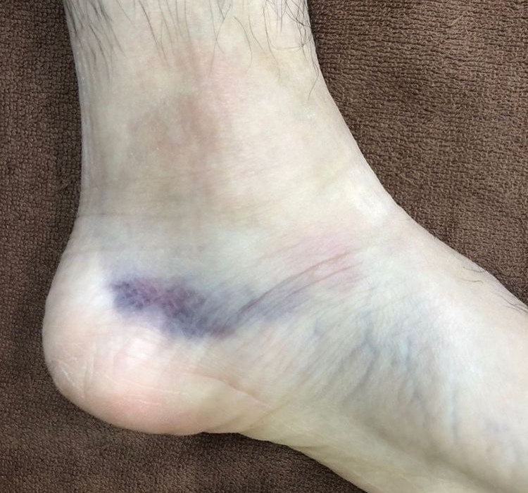 足関節捻挫内出血
